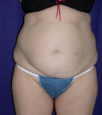 Tummy Tuck (abdominoplasty)