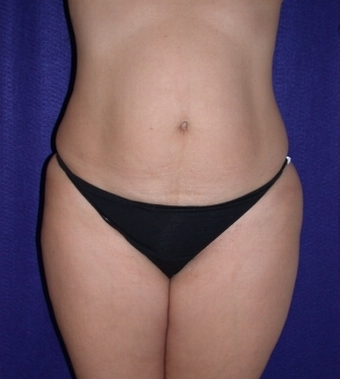 Tummy Tuck (abdominoplasty)