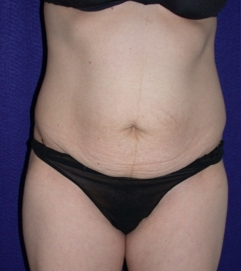 Tummy Tuck (abdominoplasty)