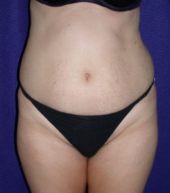 Tummy Tuck (abdominoplasty)