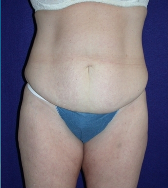 Tummy Tuck (abdominoplasty)