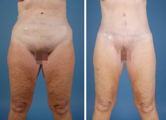 Flank Excision, Abdominoplasty Scar Revision, Liposuction of the Back