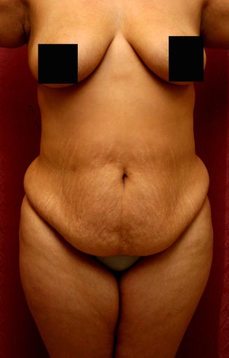 tummy tuck