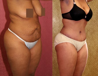 tummy tuck 