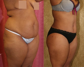 tummy tuck