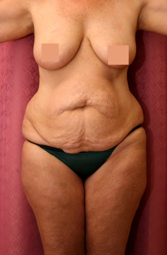 tummy tuck