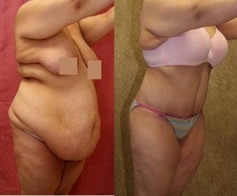 tummy tuck