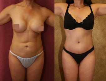 tummy tuck