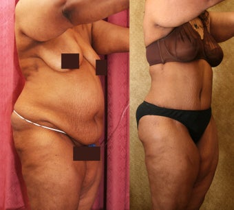tummy tuck