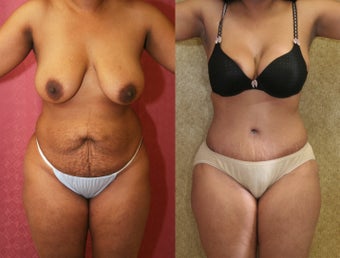 tummy tuck