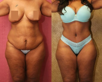 tummy tuck