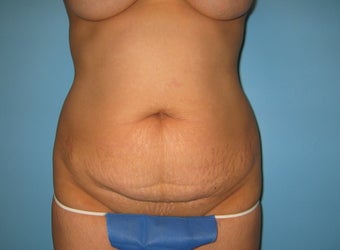 tummy tuck