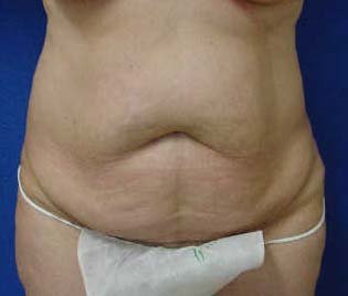 Abdomiplasty (Tummy Tuck)/Liposuction of abdomen, flanks and lateral chest areas