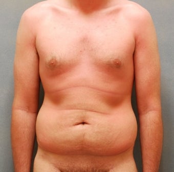 Abdominoplasty