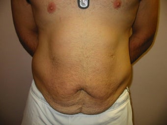 Abdominoplasty on 24 year old man