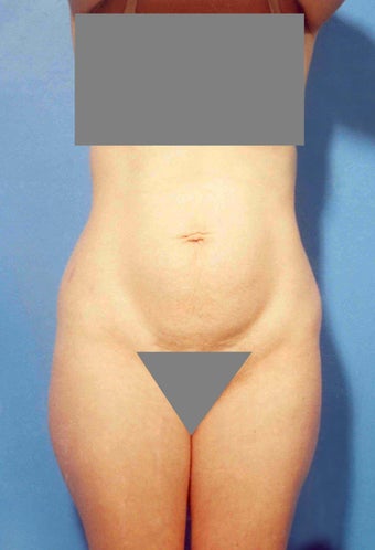 Abdominoplasty