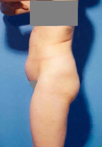 Abdominoplasty