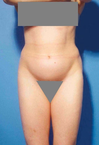Abdominoplasty