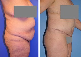 Abdominoplasty