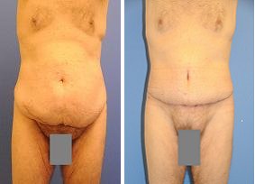 Abdominoplasty