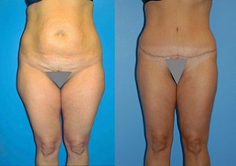 Abdominoplasty