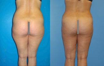 Abdominoplasty