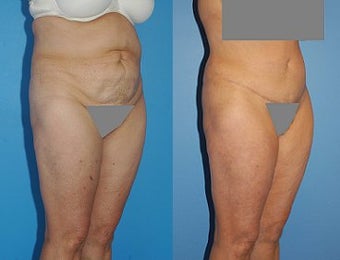 Abdominoplasty