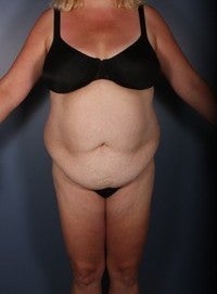 Tummy Tuck, Liposuction