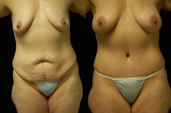 Tummy Tuck and Breast Augmentation, gel implants
