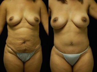 Tummy Tuck and Breast Augmentation