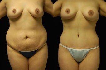 Tummy Tuck and Breast Augmentation- gel implants