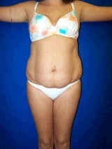 Tummy Tuck (Abdominoplasty)
