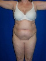 Tummy Tuck (Abdominoplasty)