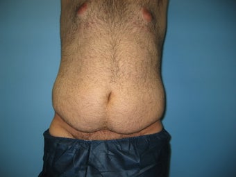 Male tummy tuck