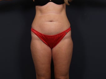 Tummy Tuck