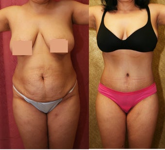 abdominoplasty- tummy tuck