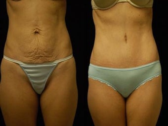 Abdominoplasty