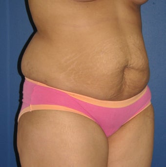 Tummy Tuck