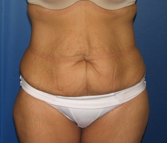 Tummy Tuck