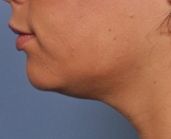 Skin Tightening