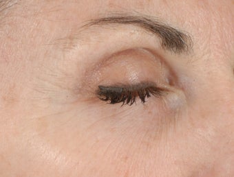 Ulthera Laser Skin Tightening