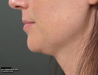 Ulthera Laser Skin Tightening