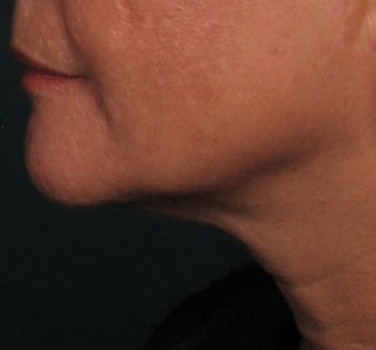Ulthera Laser Skin Tightening