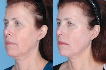 Ulthera Full Face and Neck