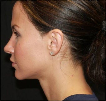 Ultherapy
