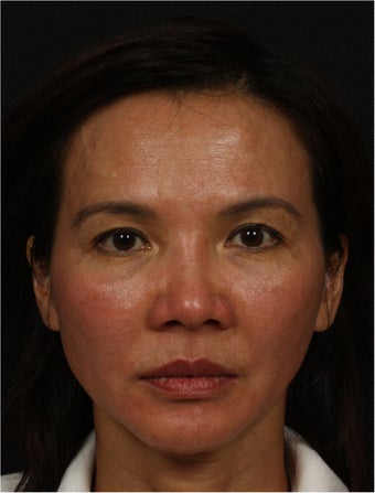 Ultherapy