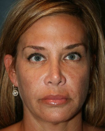 Ultherapy 