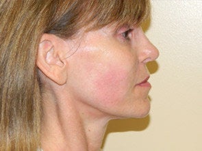 Ultherapy