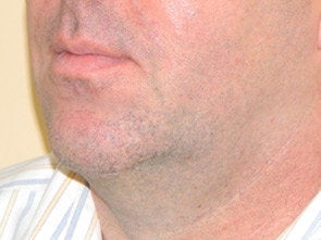 Ultherapy