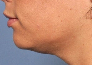 Ultherapy